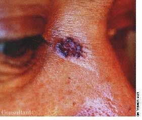 Basal Cell Carcinoma on Face of a 54-Year-Old Farm Worker
