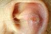 Ulcerated, Tender Nodule on the Ear 