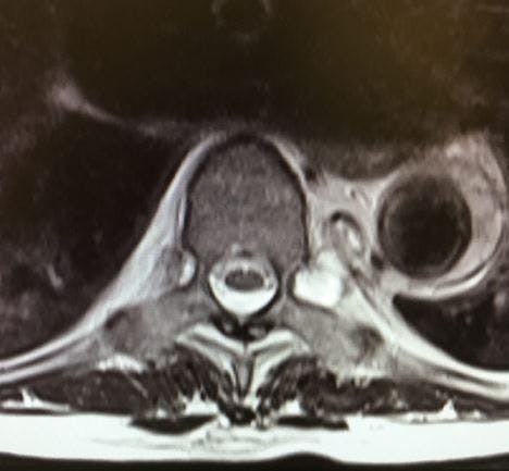 Seen in the ED: Back Pain while on Eliquis Image courtesy of Brady Pregerson, MD 