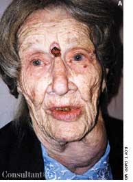 Basal Cell Carcinoma on Face of a 91-Year-Old Woman