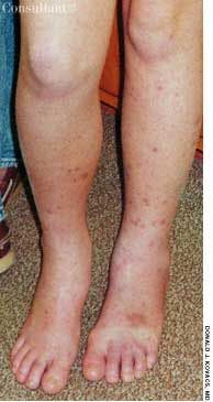 Girl With Palpable Purpura and Ecchymoses