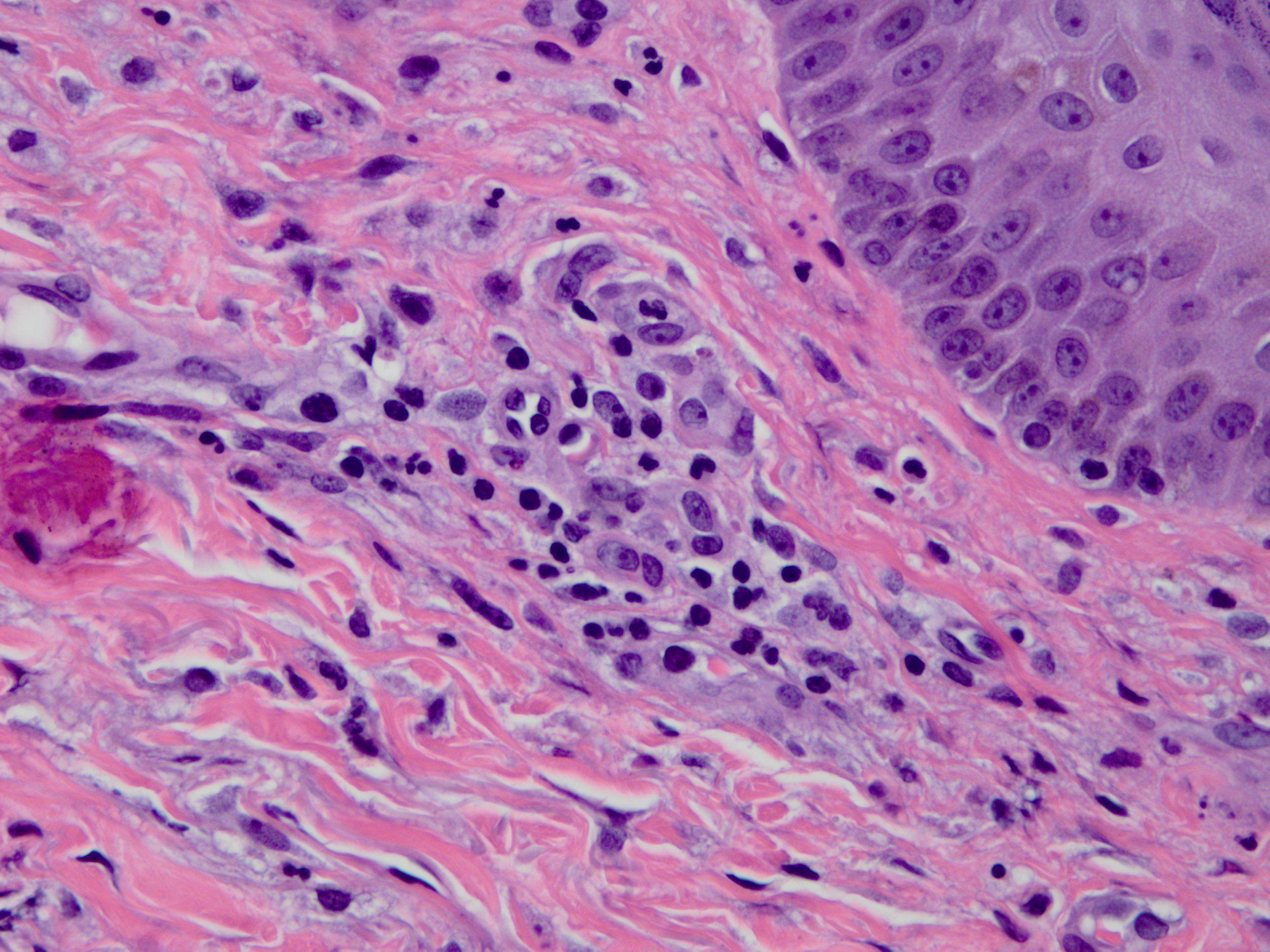 Cutaneous Leukocytoclastic Vasculitis