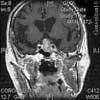 Pituitary Macroadenoma in a 77-Year-Old Man