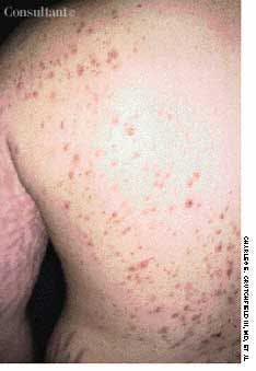 Steroid Acne