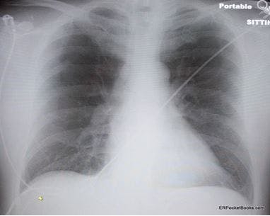 Dyspnea on Exertion in a Middle-Aged Man