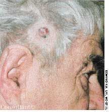 Squamous Cell Carcinoma on the Scalp