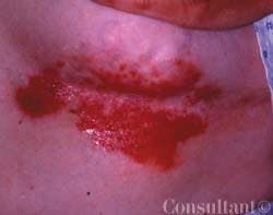 Blistering Skin Condition: Hailey-Hailey Disease