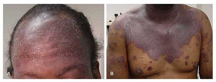 Severe Psoriasis in Advanced HIV Infection