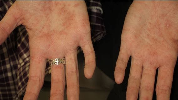 pustular rash developed on hands