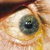 Filamentary Keratopathy and Dry Eye Syndrome