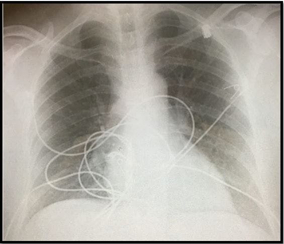 Hypoxia and Normal Chest X-ray in a Young Woman 