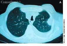 Adenocarcinoma of the Lung in a 67-Year-Old Man