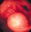 Gastric Submucosal Tumor