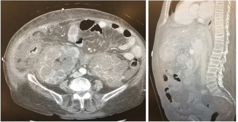 CT abdomen, sagittal and transverse views