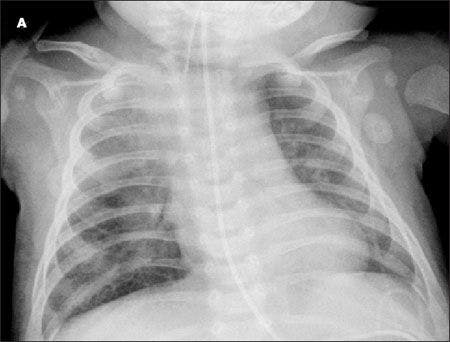 Respiratory Disorders-A Photo Essay