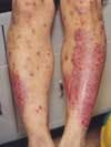 Psoriasis in a 13-Year-Old Boy