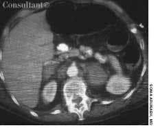 Bilateral Adrenal Hemorrhage in a Woman With Deep Venous Thrombosis