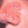 Tinea Corporis on the Nose of a 6-Year-Old Boy
