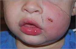 Dog Bite in a 2-Year-Old Boy