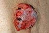 In-Situ Malignant Melanoma In A Mole that Changed Appearance