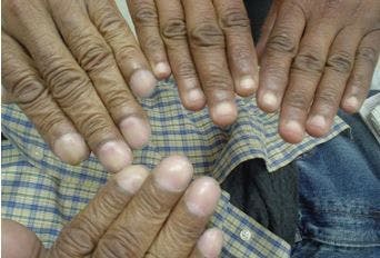 Fingernail clubbing, lung cancer