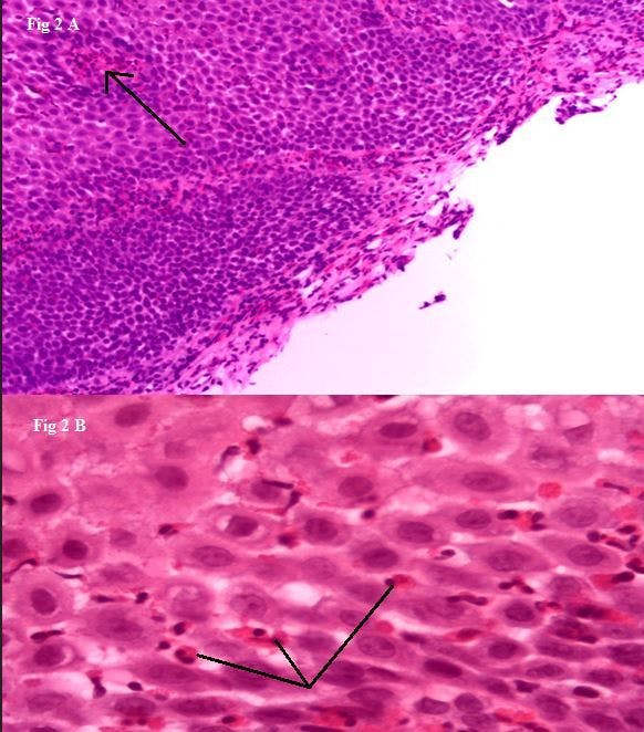 Eosinophilic esophagitis histology