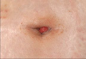 A Woman With Vaginal Bleeding and Exuberant "Umbilical Granulation Tissue"