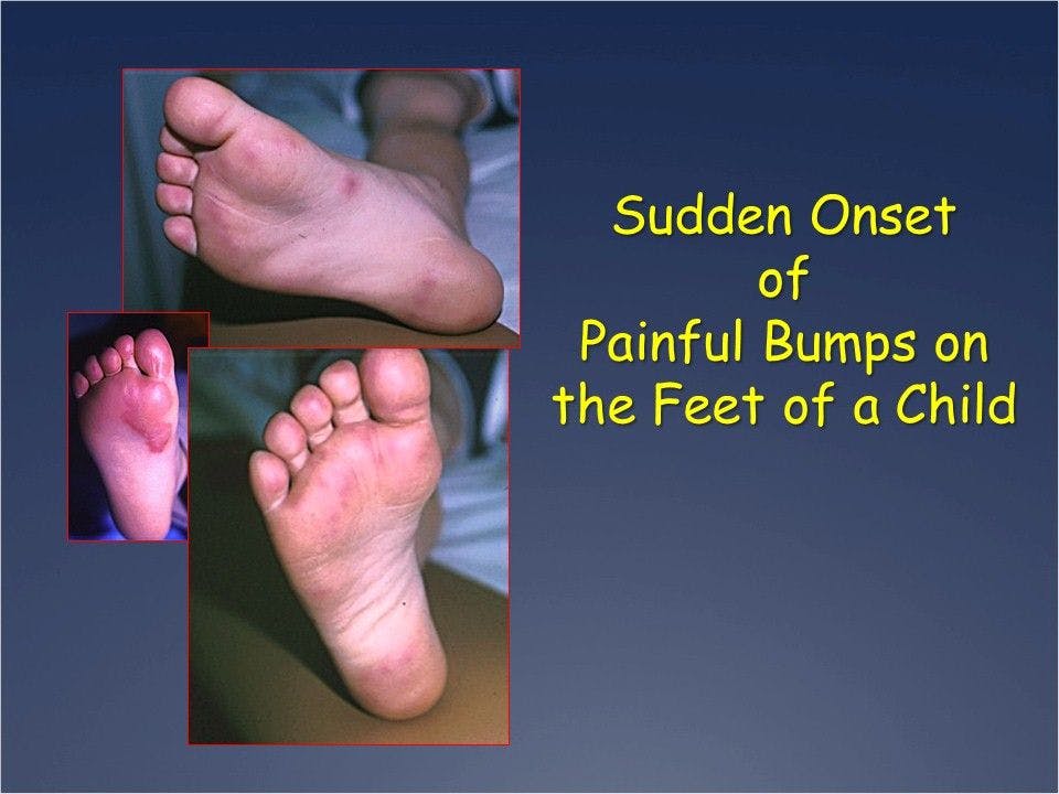 Sudden, Painful Bumps on the Feet of a Child 
