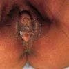Clitoral Hypertrophy From Maternal Medication