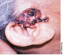 Basal Cell Carcinoma on Face of a 75-Year-Old Woman