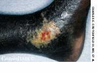 Sickle Cell Ulcer