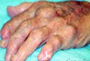 Doctors Beware: Certain Antihypertensives Can Increase the Risk of Gout