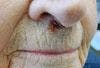 Basal Cell Carcinoma on Face of an 82-Year-Old Woman