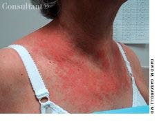 Cutaneous T-Cell Lymphoma in a Woman  With Pruritic, Erythematous Rash