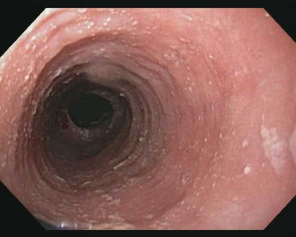 Eosinophilic Esophagitis: Which Rx When and for How Long?