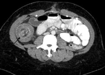 Adult Intussusception: A Rare Cause of Bowel Obstruction