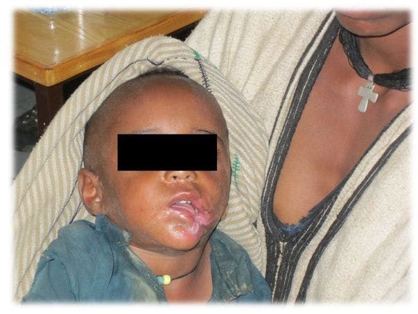 A Young Child with a Devastating Facial Lesion