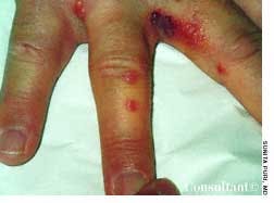 Herpes Simplex of the Fingers