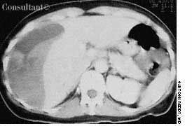 Subcapsular Hematoma of Liver