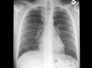 Hemoptysis in a Previously Healthy Young Man