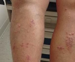 Pruritic Papulovesicular Rash on Lower Legs: Your Dx?
