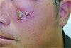 Periorbital Cellulitis Caused by Methicillin-Resistant Staph aureus (MRSA)