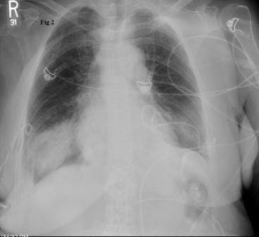 Re-Expansion Pulmonary Edema in an Older Woman