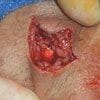 Suturing and Wound Closure: How to Achieve Optimal Healing
