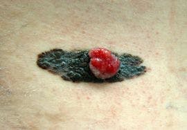 Go For The Glory Quiz: Livedo Reticularis; Persistent Fatigue; Groin Rash; Paraneoplastic Syndrome; and, a "Funny" Mole.
