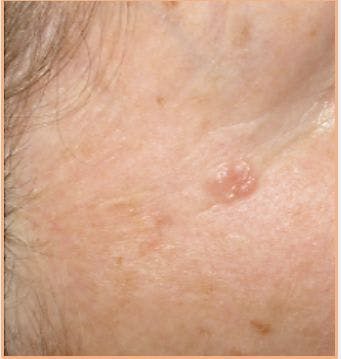 A Pearly-pink Lesion on a 68-year-old Woman 