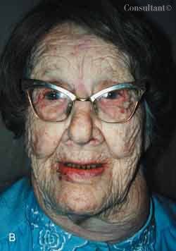 Basal Cell Carcinoma in a 91-Year-Old Woman