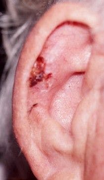 Ulcerated Lesion on Ear