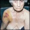 Shoulder Fracture-Dislocation in an Elderly Woman: Would You Operate?
