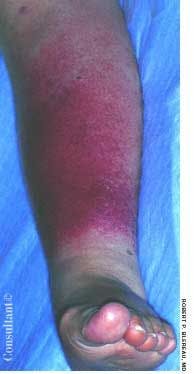 Streptococcal Cellulitis of the Leg
